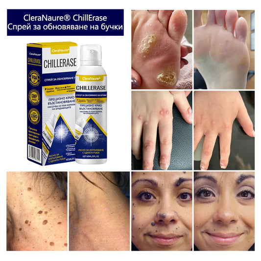 CleraNaure® ChillErase спрей за възстановяване на неравности
