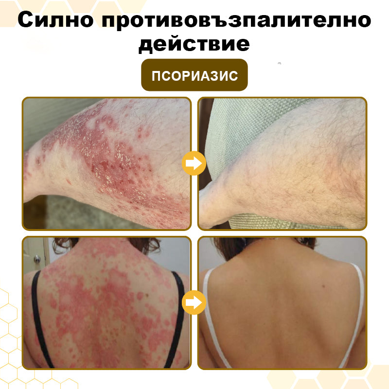 CleraNaure® PsoriaSoothe – Възстановяващ крем с пчелна отрова за кожа, склонна към псориазис