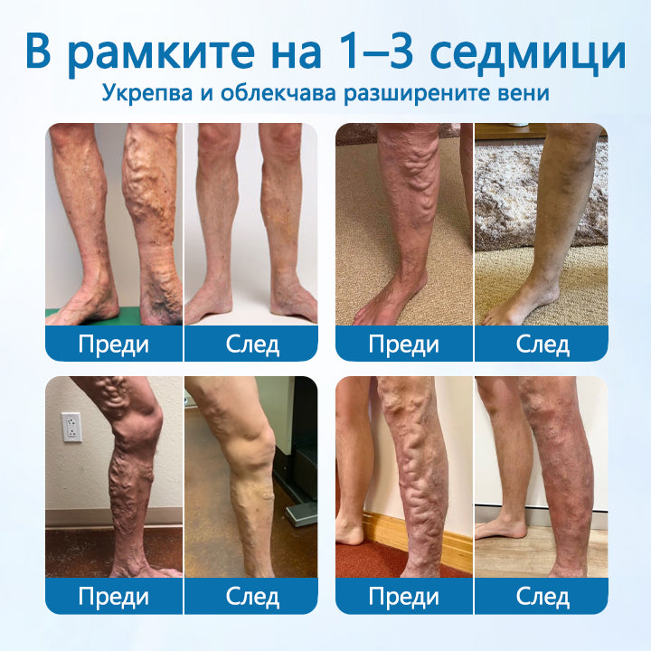 🕊️CleraNaure® VeinGuard Билков Спрей - ✅ Клинично доказано, че премахва разширените вени само за 7 дни!🪶🪶