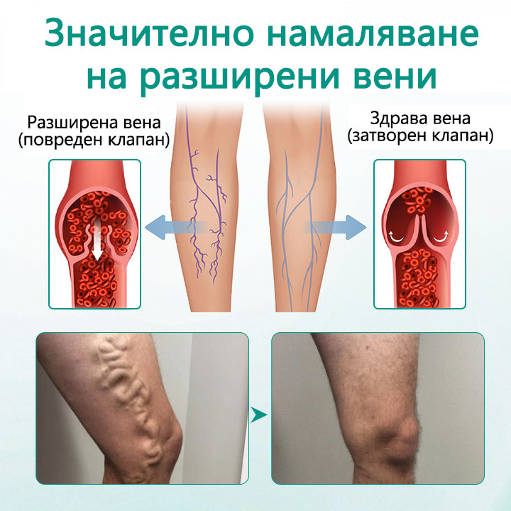 CleraNaure® LegRenew за варикозни вени
