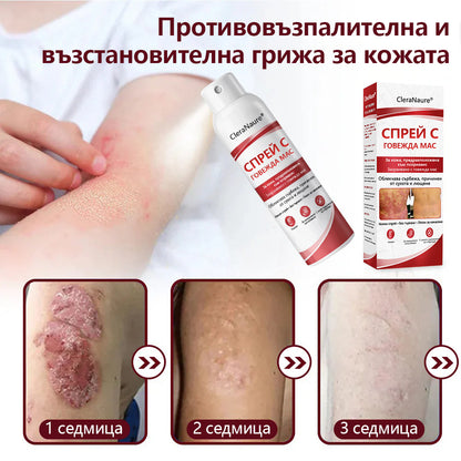 🥇CleraNature® Beef Tallow Spray за сърбяща, лющеща се кожа от псориазис🥇
