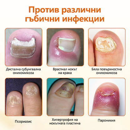 CleraNaure® FungiBee Напреднал Спрей за Ремонт на Нокти